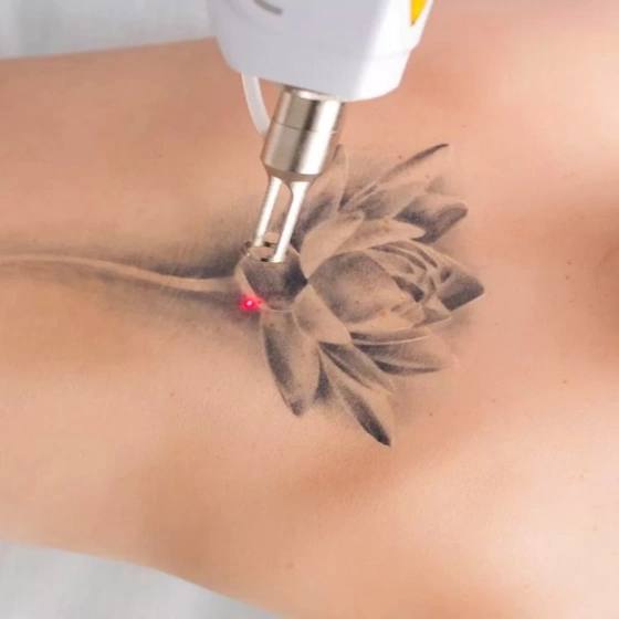 Что стоит знать, прежде, чем удалить татуировку лазером?