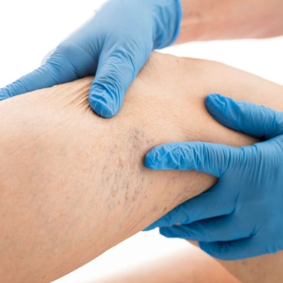 Варикоз: причины, симптомы и лечение