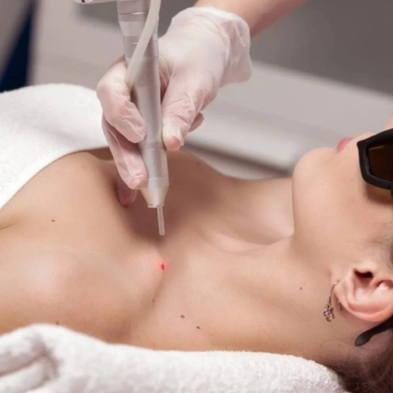 Почему эффективнее удалять новообразования лазером