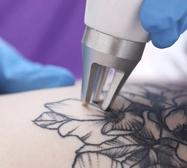 Удаление татуировок