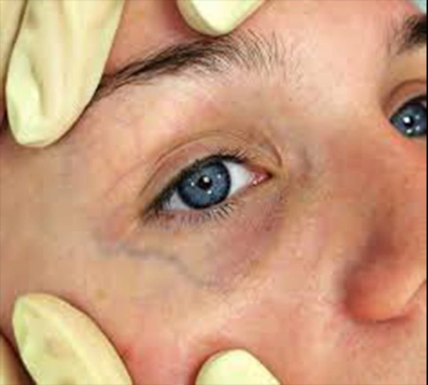 Лечение периорбитальных вен (удаление вен вокруг глаз)