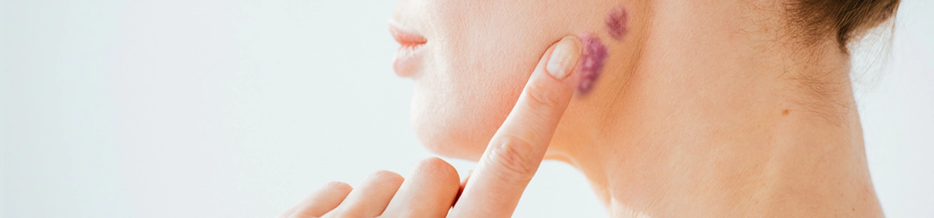 Удаление гемангиом