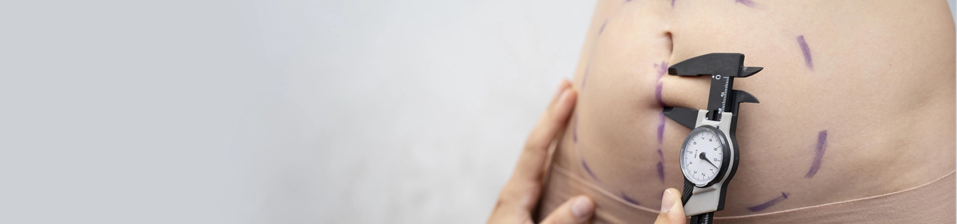 Абдоминопластика (подтяжка живота)