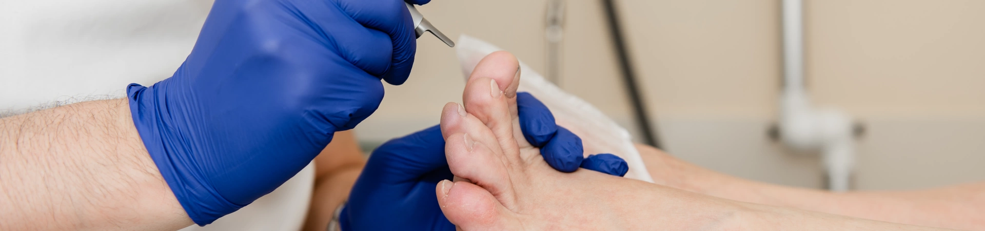 Удаление вросшего ногтя лазером CO 2