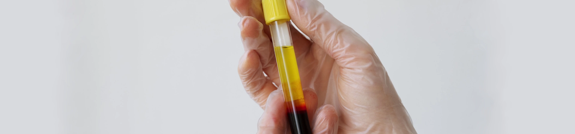 Плазмотерапия