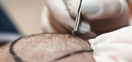 Трансплантация волос в ШайнЭст