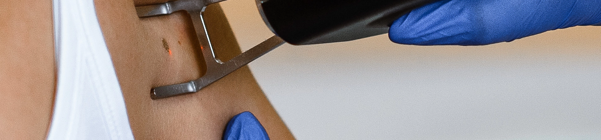 Лечение шрамов, рубцов