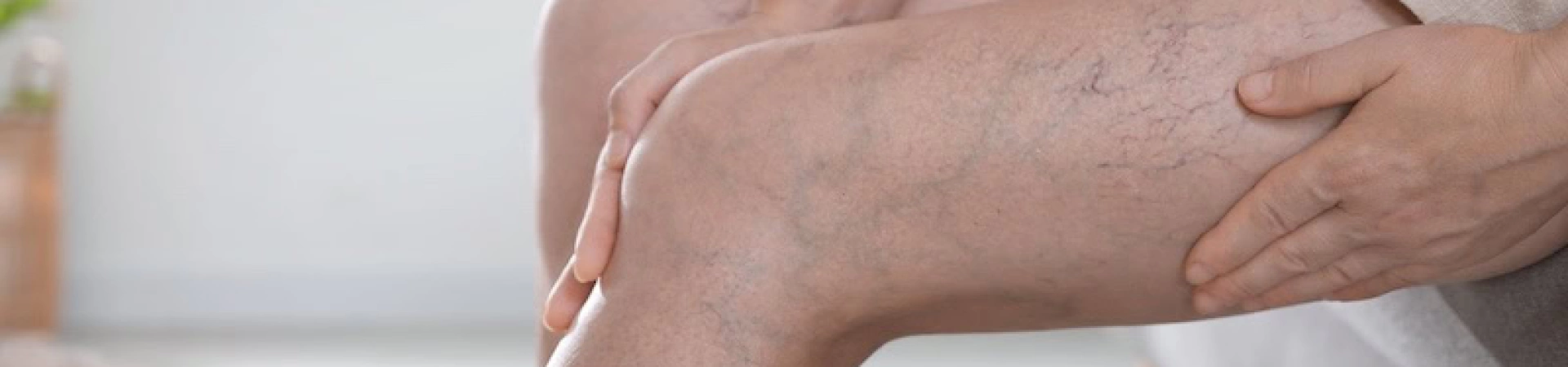 Эндовенозная лазерная коагуляция вен (ЭВЛК)