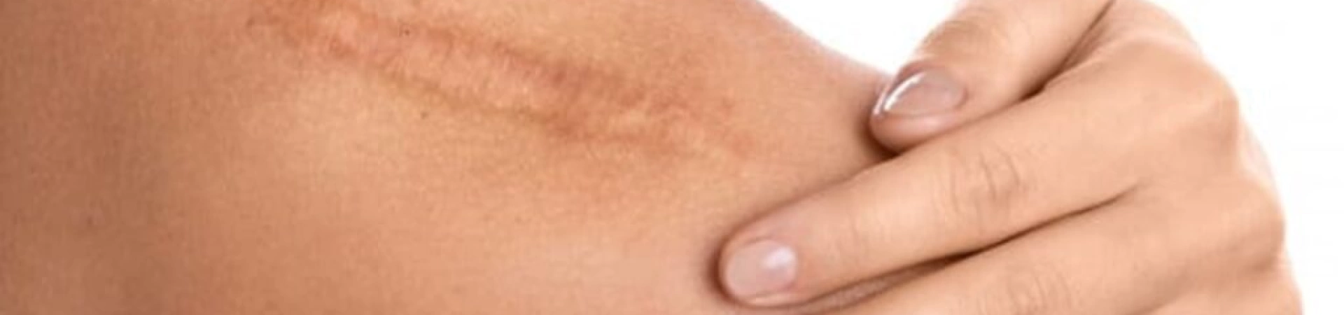 Удаление рубцов с пластикой местными тканями в Минске