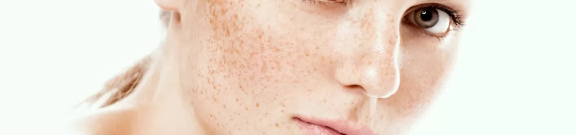 Лечение поверхностной пигментации фотонасадкой