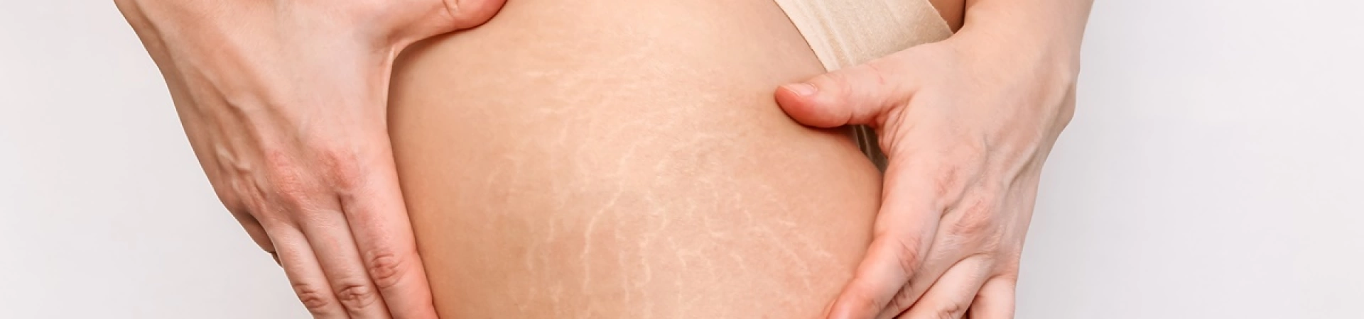 Лазерное удаление растяжек