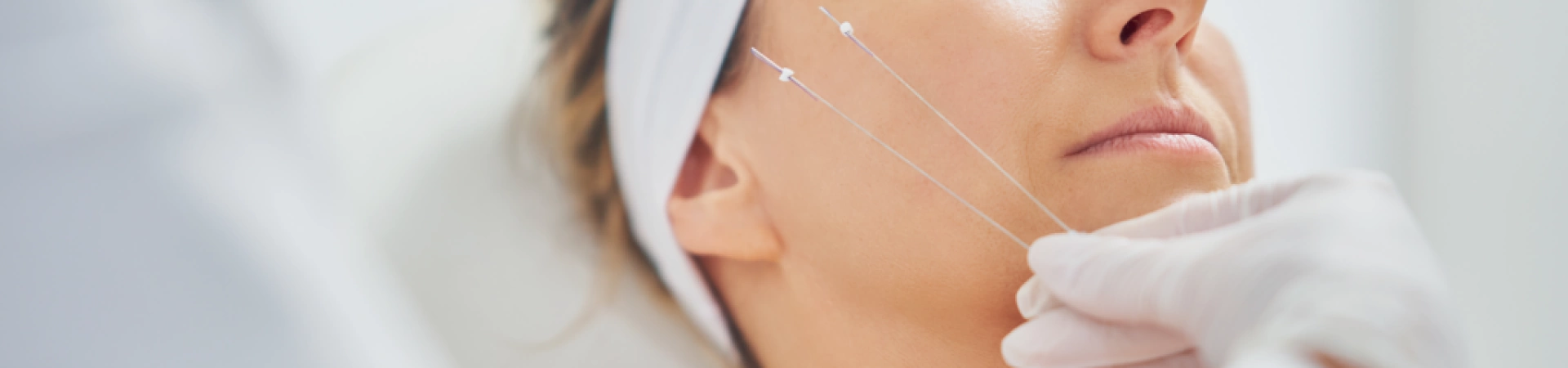 Нитевой лифтинг