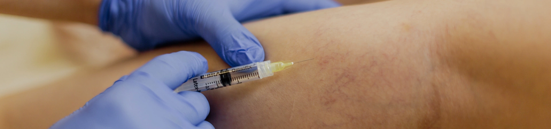 Склеротерапия