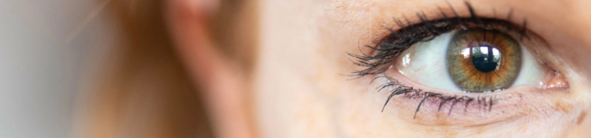 Лечение периорбитальных вен (удаление вен вокруг глаз)