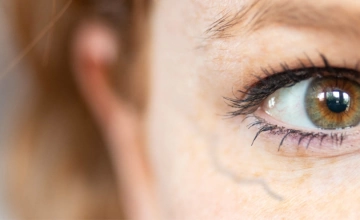 Лечение периорбитальных вен (удаление вен вокруг глаз)