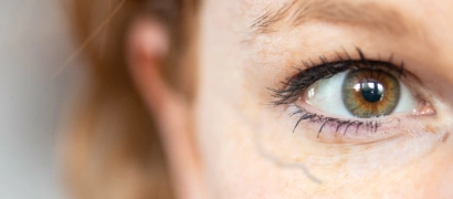 Лечение периорбитальных вен (удаление вен вокруг глаз)