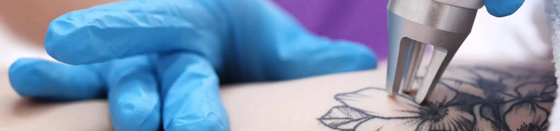 Удаление татуировок