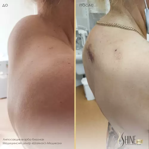 Липосакция седьмого шейного позвонка («горб бизона») | Shine-est.by