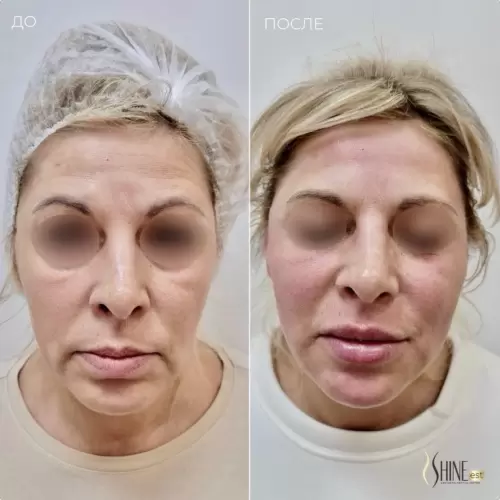 Aptos Excellence Visage НА | Shine-est.by