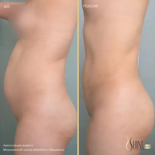 Липосакция передней стенки живота | Shine-est.by