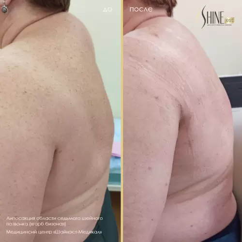 Липосакция седьмого шейного позвонка («горб бизона») | Shine-est.by