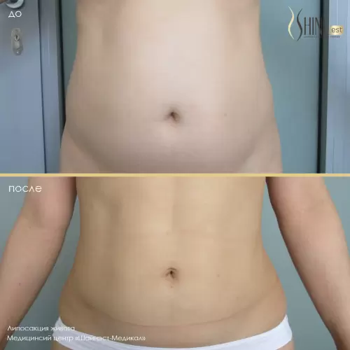 Липосакция передней стенки живота | Shine-est.by