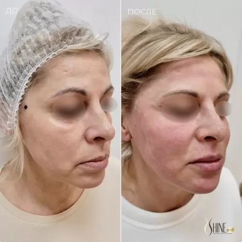 Aptos Excellence Visage НА | Shine-est.by