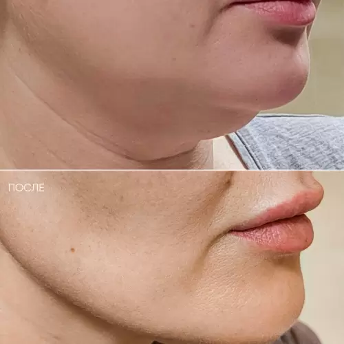 Липосакция + удаление комков Биша | Shine-est.by